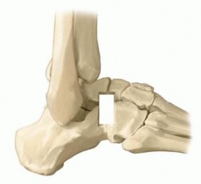 Illustration 9 for Expert Guide to Triple Arthrodesis et al. for Hindfoot