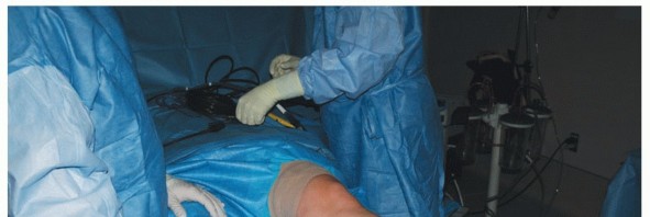 Illustration 4 for Painful Talus Lesions? The tech fig c Osteochondral Transfer Solution