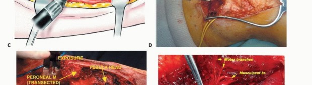 Illustration 20 for Beyond Amputation: The Type I Resection in Fibular Tumor Surgery