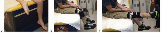 Illustration 15 for Treatment for Congenital Femoral Deficiency: What You Need to Know