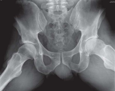 Illustration 85 for Metal on Metal Resurfacing: Enhanced Posterior Soft Tissue Repair