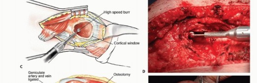 Illustration 39 for Mastering Femoral Metastases: Optimal Function for Femoris & Vastus