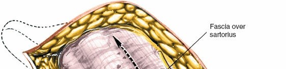 Illustration 31 for Unlocking Every Aspect of the Hip's Surgical Approaches