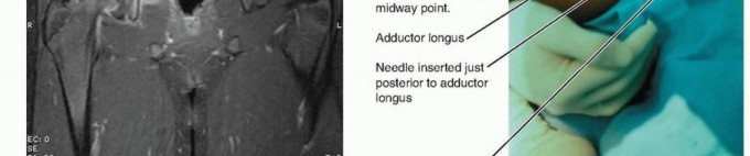 Illustration 7 for Septic Hip in Children: Mastering Anterior Drainage for Optimal Recovery