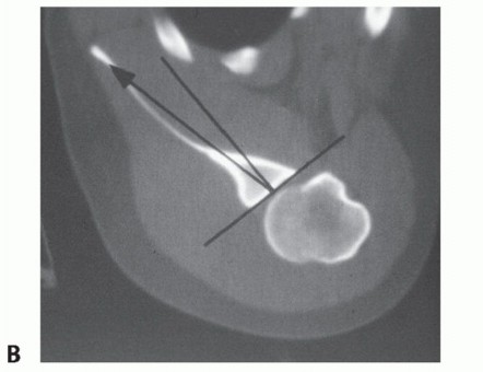 Illustration 3 for Finally Treat Recurrent Posterior Instability of the Shoulder