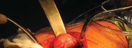 Illustration 40 for Metal on Metal Resurfacing: Enhanced Posterior Soft Tissue Repair