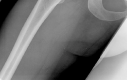 Illustration 4 for Bernese Periacetabular Osteotomy: Your Definitive Case Title Bernese