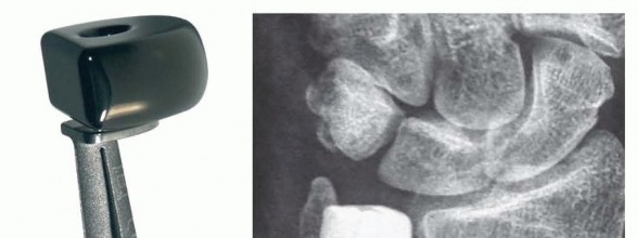 Ulnar Head Implant Arthroplasty