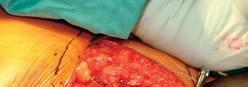 Illustration 60 for Direct Lateral Hip: Optimize Exposure with Sharp Curved Hohmann