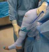 End Chronic Synovitis: Arthroscopic Relief with Portal & Shaver