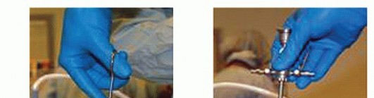 Illustration 6 for Posterior Talar Process: Endoscopic Solutions for Ankle Pain