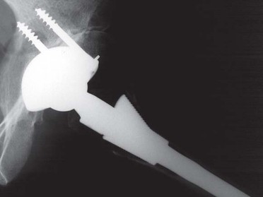 Illustration 108 for Successful Total Hip Replacement in Developmental Dysplasia