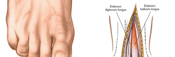 Illustration 6 for Optimized Approaches to the Dorsum of the Foot & Ankle
