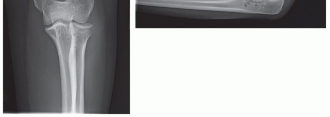 Illustration 45 for Radial Head & Neck Fractures: Mastering ORIF for Best Results