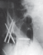 Illustration 28 for Advanced Arthroplasty for Malignant Lesions: Reclaim Your Mobility