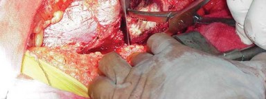 Illustration 19 for THA for patients with proximal femoral deformity: Practical solutions