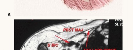 Illustration 3 for Axillary Space Exploration: Surgical Resection of Complex Tumors