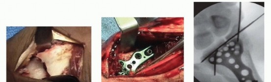 Illustration 13 for Arthroscopic Fixation: Effectively Treating Radial Styloid Fragments