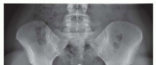 Illustration 12 for Hip Arthroscopy: Your Minimally Invasive Solution for Hip Pain