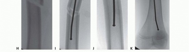 Illustration 16 for Pediatric Femoral Nailing: Targeting the Right aspect of the greater Trochanter