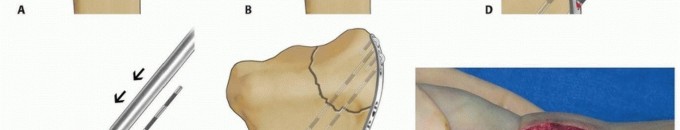 Illustration 33 for Fragment-Specific Fixation: Restore Carpal Facet Horizon