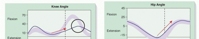 Illustration 3 for Rectus Femoris Muscle Transfer: Restore Gait & Function