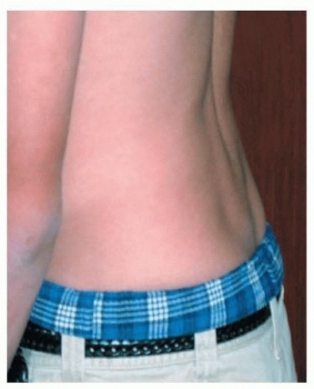 Illustration 4 for Mastering High-Grade Spondylolisthesis: Posterolateral and Interbody Fusion