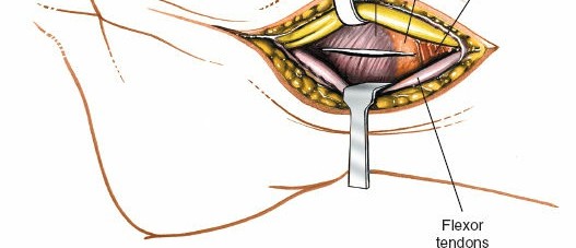 Illustration 73 for Essential Surgical Approaches: Uncover Every Aspect of the Wrist