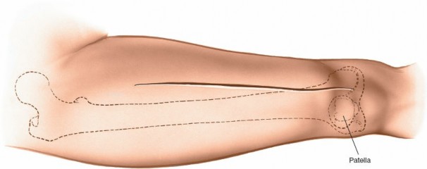 Illustration 28 for Optimal Femoral Approaches: Mastering the Lateral Intermuscular Septum
