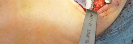 Illustration 24 for Collum Femoris Preserving: Achieve Better Primary Hip Outcomes