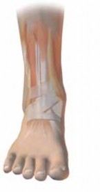 Illustration 36 for Optimizing ORIF for Tibial Plafond Fractures: A Modern Approach