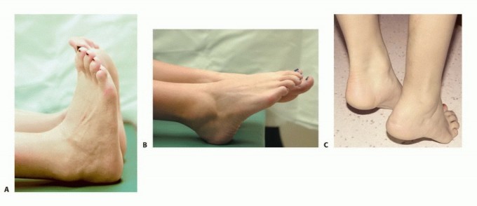 Illustration 16 for Soleus Resection for Tumors: Protecting the Heads of the Gastrocnemius