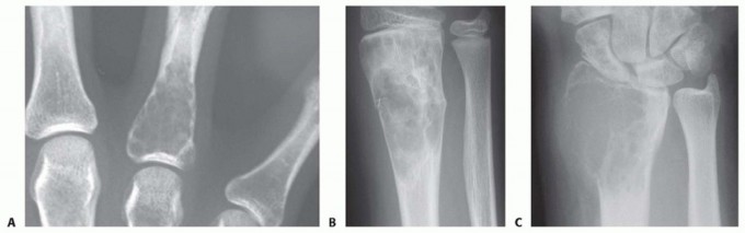 Treatment of Enchondroma, Bone Cyst, and Giant Cell Tumor of the Distal Upper Extremity
