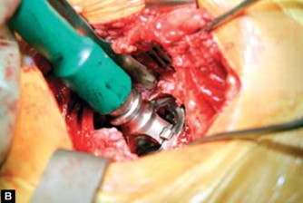 Illustration 40 for Optimizing Acetabular Component Cementation for Superior Outcomes