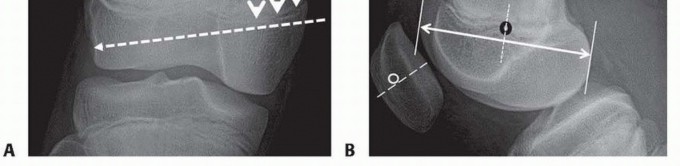 Illustration 11 for Chronic Patellar Instability: From Acute Onset to Lasting Solutions