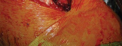 Illustration 81 for S-ROM: Inside the Technique of Modular Implant Design