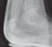 Illustration 29 for Optimal Fixation of the Ankle: Open Reduction & Internal Fixation