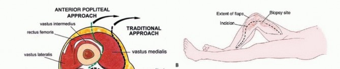 Illustration 23 for Advanced Distal Femoral Resections: Limb-Sparing Outcomes & Techniques