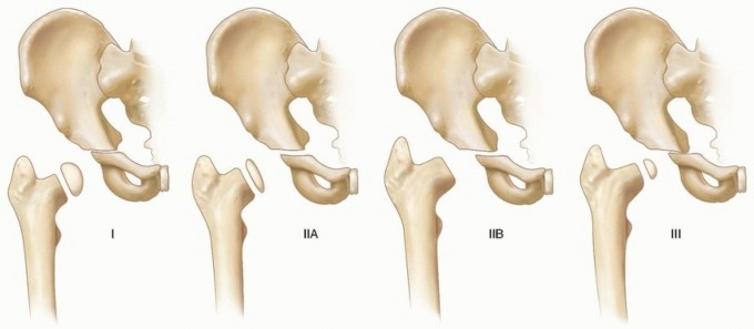 Illustration 23 for Septic Hip in Children: Mastering Anterior Drainage for Optimal Recovery
