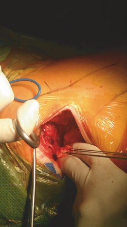 Illustration 5 for Mastering Direct Anterior Approach Hip Arthroplasty Without a Traction Table