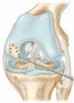 Illustration 17 for Microfracture Chondroplasty: How Tiny Holes Are Made to Fix Cartilage