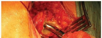 Illustration 32 for Why Polished Tapered Cemented Stems Excel in Hip Replacement