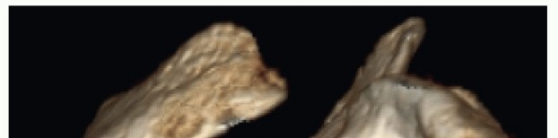 Illustration 6 for Glenoid Bone Graft for Anterior Shoulder Instability: Restore Stability