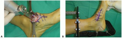 Illustration 59 for Mastering Midfoot Arthrodesis: Protect the Deep Neurovascular Bundle