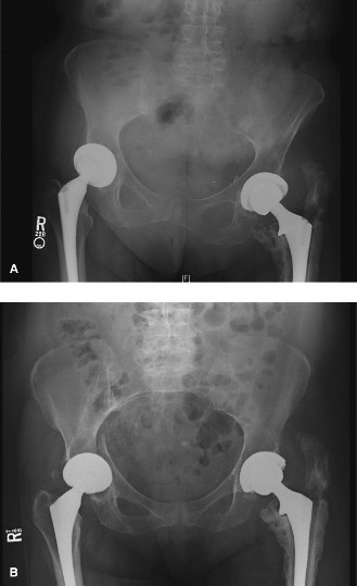 Periprosthetic Hip Fractures: Evaluate & Treat Complex Cases