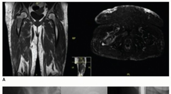 Illustration of allograft prosthetic composite - Dr. Mohammed Hutaif