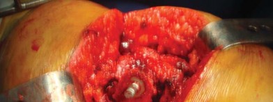 Illustration 56 for The Silent Hip: Achieving a Truly Silent, Pain-Free Joint