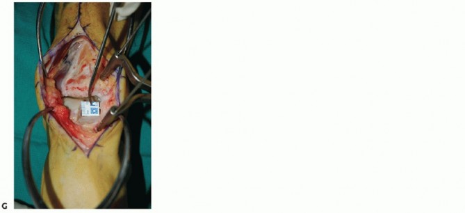 Illustration 34 for Unlock Healing: Medial Malleolar Osteotomy for Talus OLT Allografts