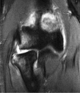 Elbow Cases: Unmasking Posterolateral Instability Pain