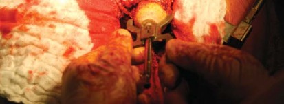 Illustration 63 for Metal on Metal Resurfacing: Enhanced Posterior Soft Tissue Repair